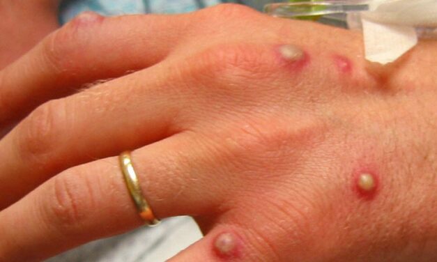 Combating Monkeypox, Colorado has 79 Confirmed Cases